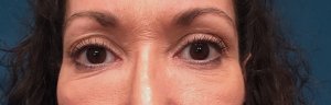 Manhattan BLEPHAROPLASTY Before 6